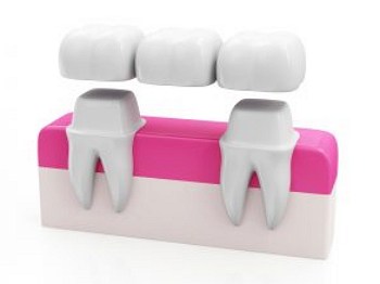 dentist in brandon ms dental Bridges header image