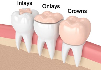 dentist brandon ms Inlays and Onlays header image